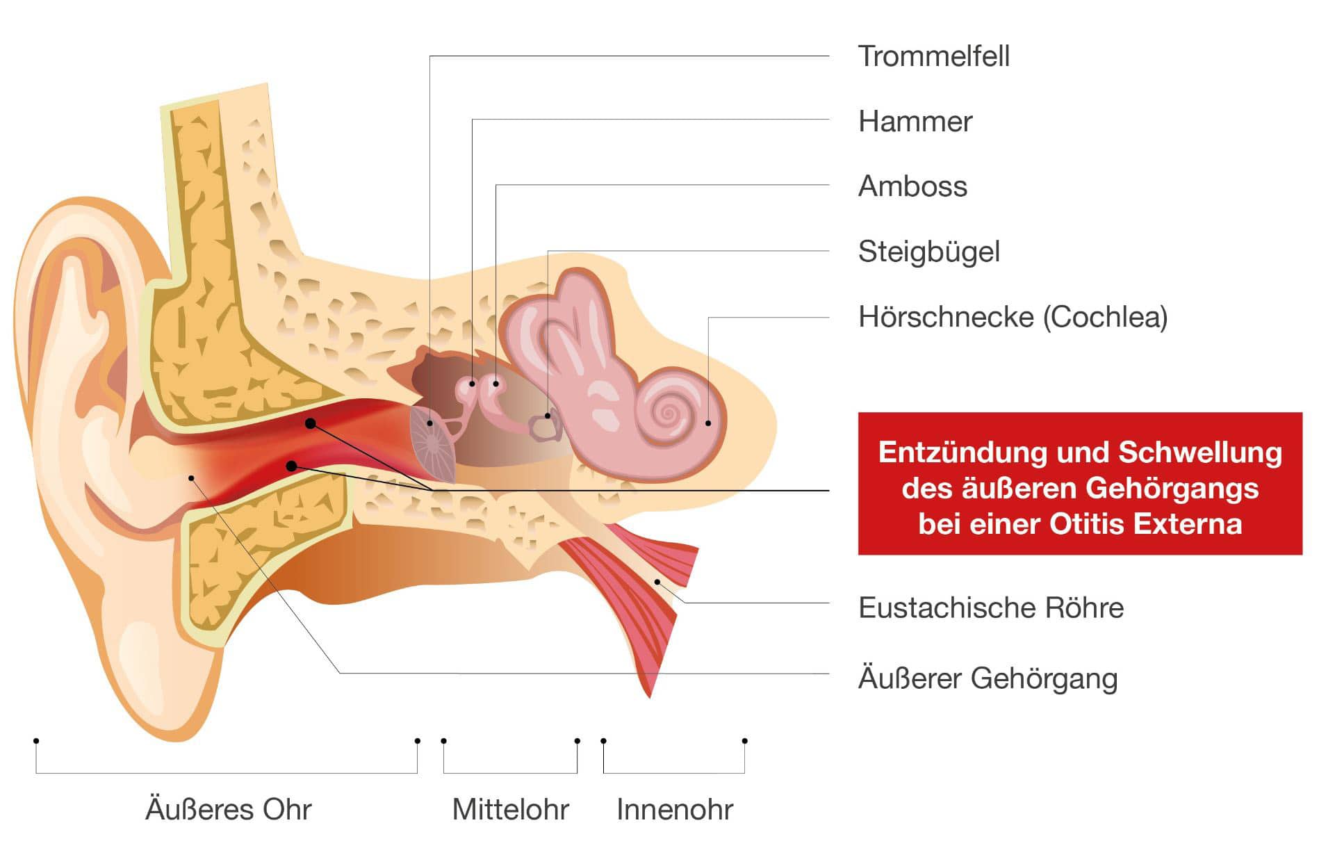Grafische Darstellung der Anatomie eines Ohres und Gehörgangsentzündung